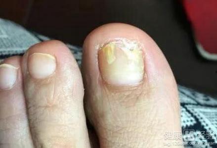 婆婆妈妈爆料灰指甲视频